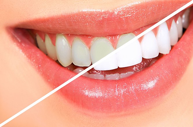 45€ Λεύκανση Δοντιών με χρήση λάμπας LED. Λευκά δόντια με εξαιρετικά αποτελέσματα, από Οδοντίατρο στην Νέα Ιωνία.